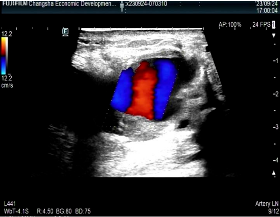 我院成功完成首例高难度肱动脉假性动脉瘤介入治疗
